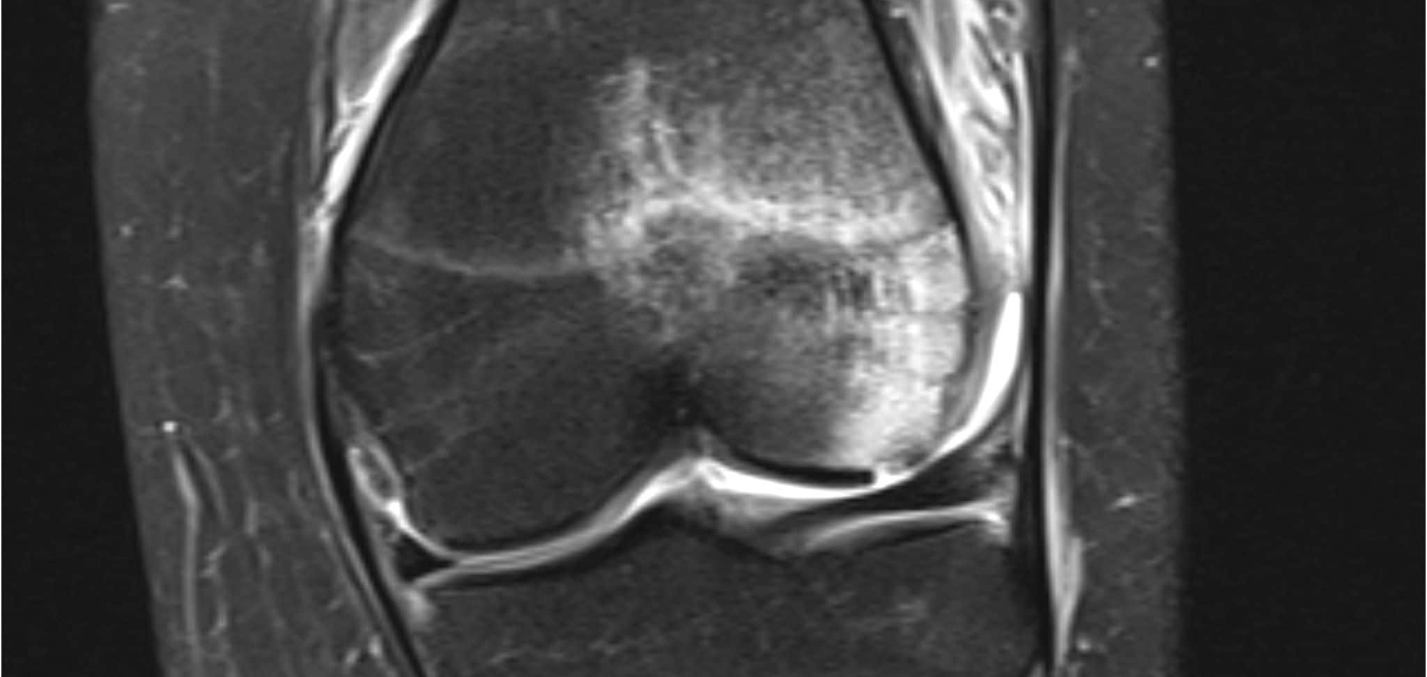Osteochondritis Dissecans in Dogs
