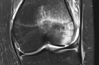 Osteochondritis Dissecans in Dogs