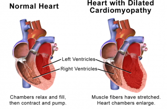 Boxer Cardiomyopathy